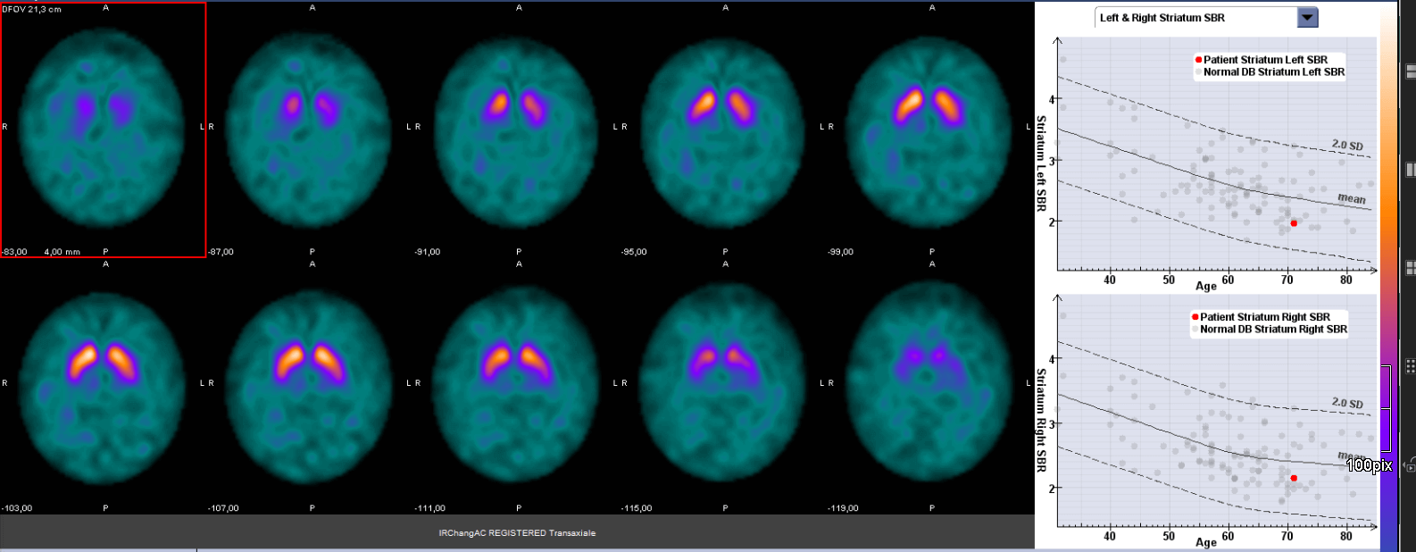 Untersuchungsergebnis einer Hirnszintigrafie (DAT-Scan) in der Nuklearmedizin am Westpfalz-Klinikum Kaiserslautern